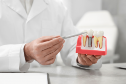 Implantes dentales. Cuidados y precauciones