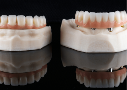 implantes dentales o protesis removible